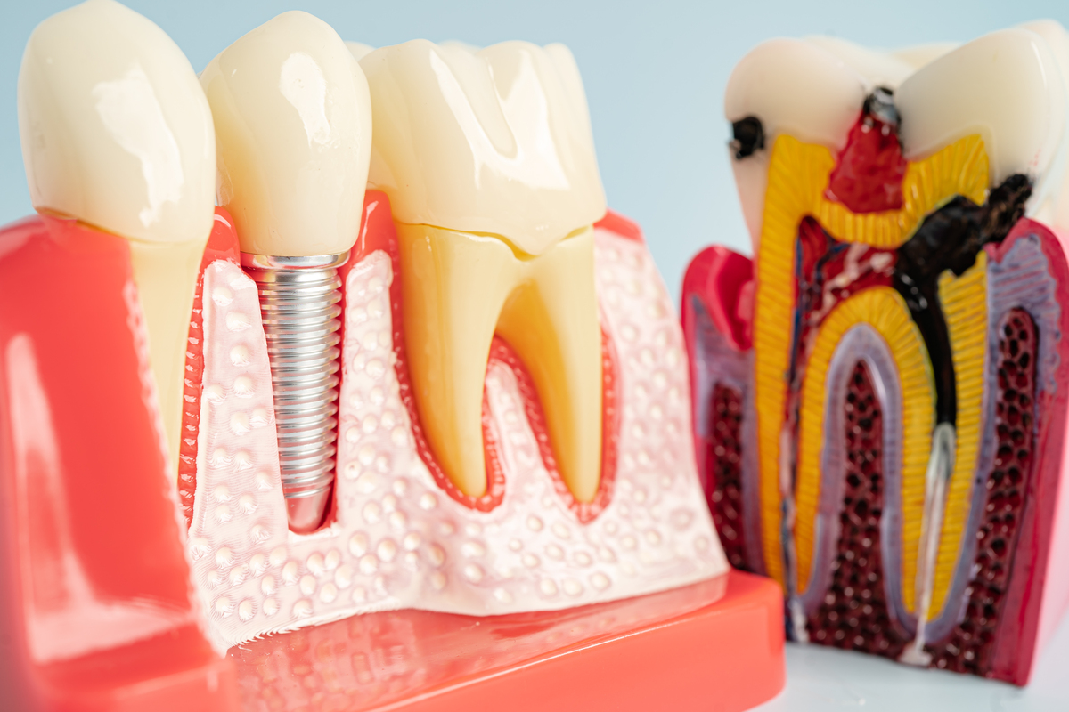 Step by step dental implant process